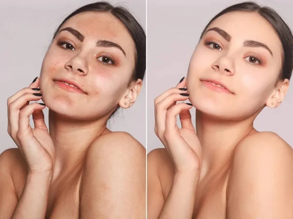 Aesthetic skin treatment